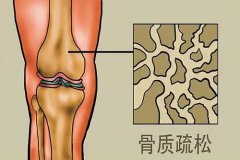 声骨密度仪分析|骨密度的正常范围是多少？哪些方法可以帮助我们提升